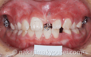 埋伏歯の牽引経過2
