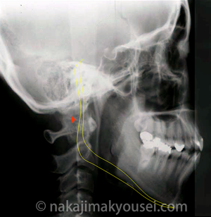 側貌のセファロより下顎下縁平面のダブルボーダーが認められる