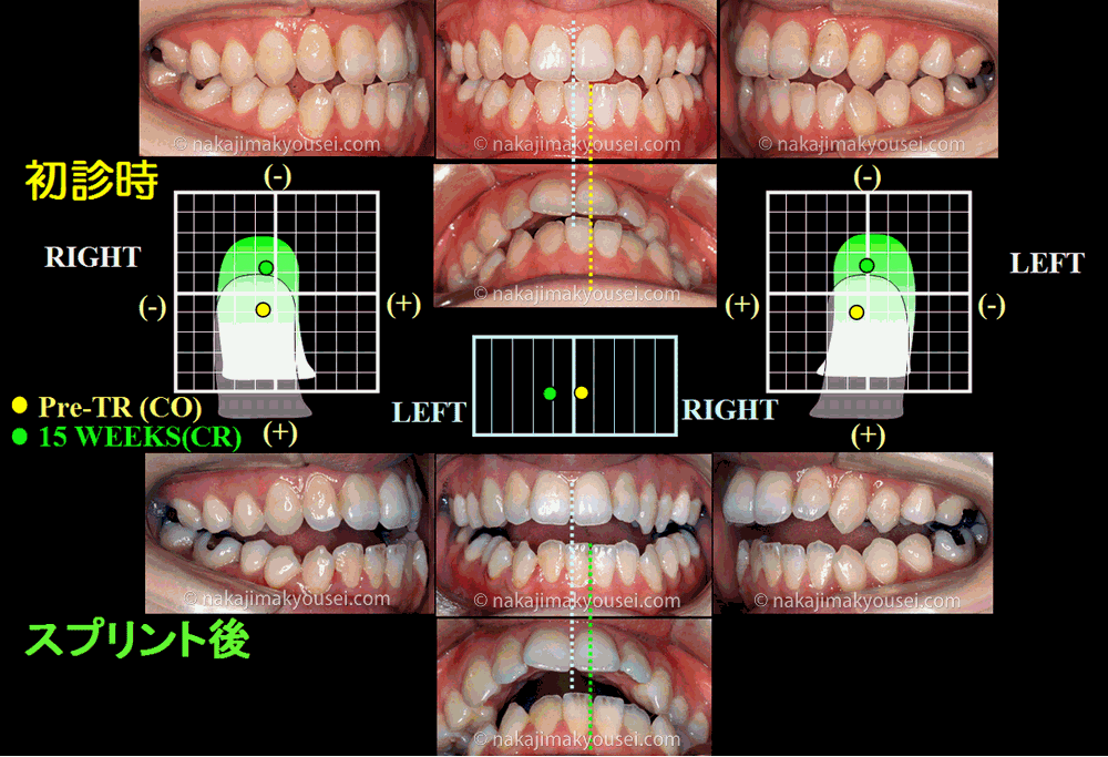 関節頭が関節窩にシーとしたことにより、口腔内でも本来のズレを確認できております。正中のズレは大きく