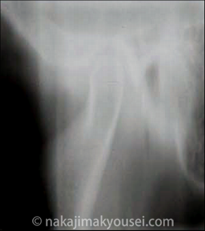 顎関節の断層写真LEFT