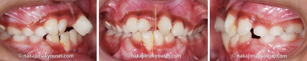 別のケースですが、前歯が１本反対で、下顎の前歯が上の前歯と干渉し揺らされているため歯肉が退縮するという機能的問題と下顎が右側に偏位し正中のずれを生じています。